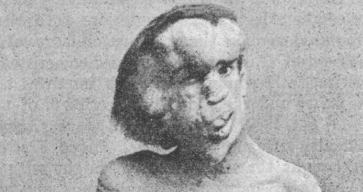 Joseph Merrick